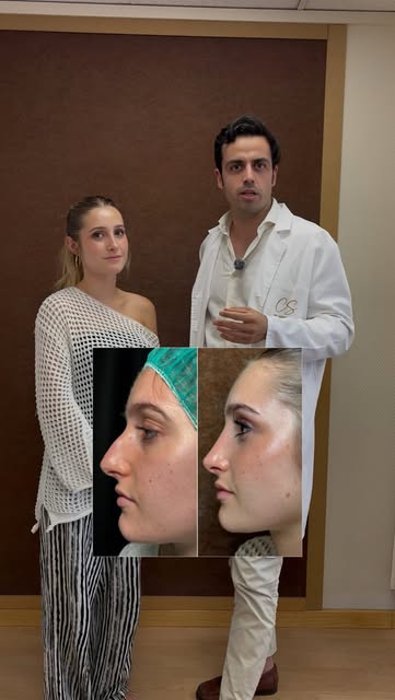 Portada del vídeo de rinoplastia cerrada a los tres meses, publicado conjuntamente por Clínica Castro Sierra y Dr. Martín Suárez
